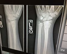 Image result for Broken Ankle Surgery