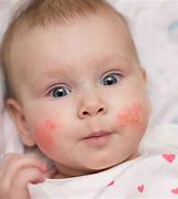 Image result for Infant Allergy