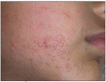 Image result for Molluscum Contagiosum Difused