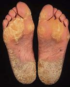 Image result for Palmar Keratosis