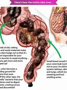 Image result for Constipation Bowel Movement