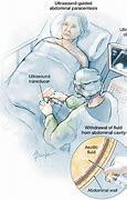 Image result for Diagnostic Paracentesis