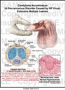 Image result for Condyloma Causes