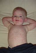 Image result for Fifith Disease Children