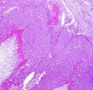 Image result for Ovarian Cyst Pathology