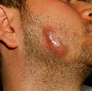 Image result for qctinomicosis
