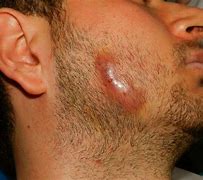 Image result for zctinomicosis