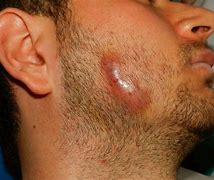 Image result for actonomicosis