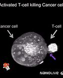 Image result for Transitional Cell Carcinoma Kidney
