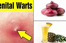 Image result for How to Remove Genital Warts