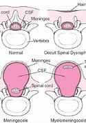 Image result for Spina Bifida with Rachischisis