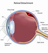Image result for Retinal Detachment Post Cataract Surgery