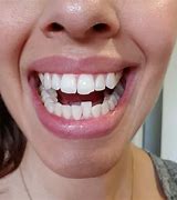 Image result for Crooked Lower Front Teeth