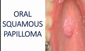 Image result for Benign Squamous Papilloma