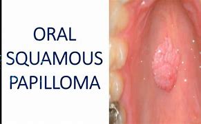 Image result for Squamous Papilloma Treatment