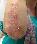 Image result for Acupuncture Points for Psoriasis