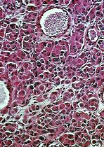 Image result for Melanoma/Skin Histology