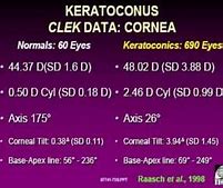 Image result for Keratoconus Soft Contact Lenses