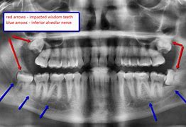 Image result for Wisdom Teeth Nerve Damage