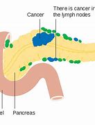 Image result for Pancreatic Cancer Lymph Nodes