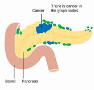 Image result for What Causes Pancreatic Cancer