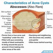 Image result for Cyst vs Abscess
