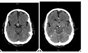 Image result for Pituitary Tumor MRI