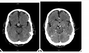 Image result for MRI Contrast for Pituitary Tumor