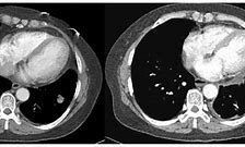 Image result for Lung Nodule 1 8 Cm