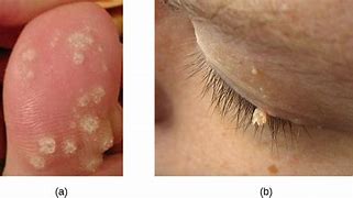 Image result for Treatment for Warts