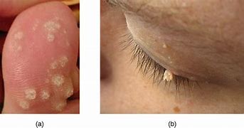 Image result for Warts Skin Growths