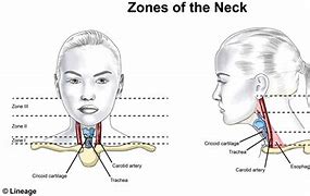 Image result for Location of Carotid Artery Bulb in Neck