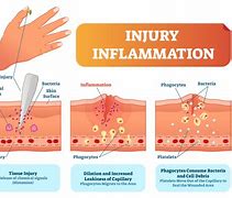 Image result for Inflammation vs Infection