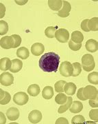 Image result for Plasmacytoid Lymphocytes vs Plasma Cells