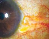 Image result for Conjunctival Papilloma