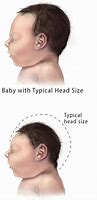 Image result for Microcephaly Behaviors