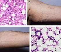 Image result for Aplastic Anemia