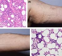 Image result for Aplastic Anemia