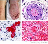 Image result for Ecthyma Differentials