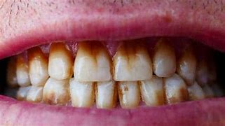 Image result for Nicotine Stains On Teeth