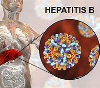 Image result for Hepatitis B