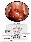 Image result for Normal Cervical Ectropion