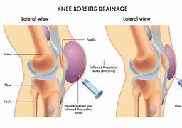 Image result for Inflamed Bursa Knee