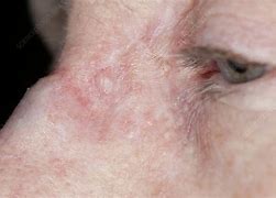 Image result for Skin Cancer On My Nose