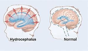 Image result for Acquired Hydrocephalus