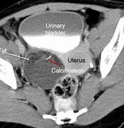 Image result for 25 Cm Ovarian Cyst