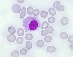 Image result for Hairy Cell Leukemia Lymphadenopathy