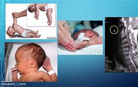 Image result for acondroplaxia