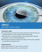 Image result for Smile Eye Surgery