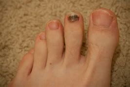 Image result for Wart On Top of Toe
